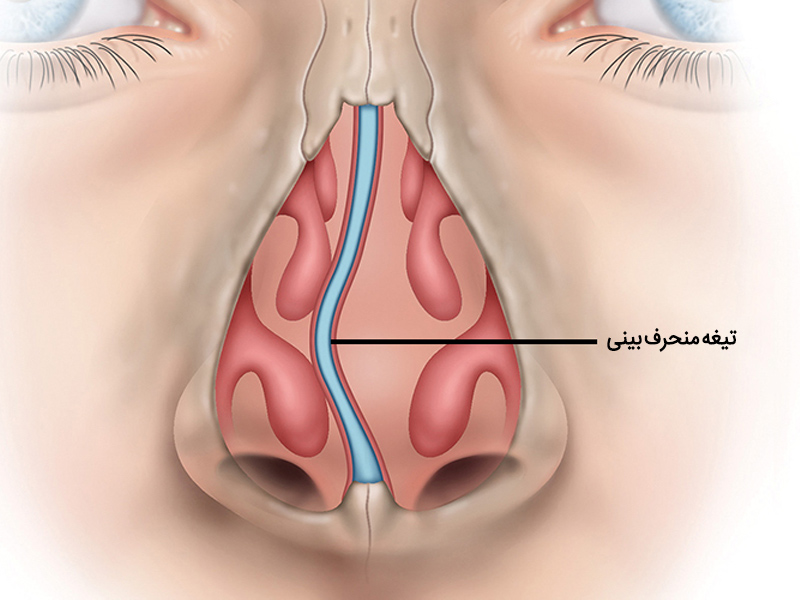 علائم انحراف بینی